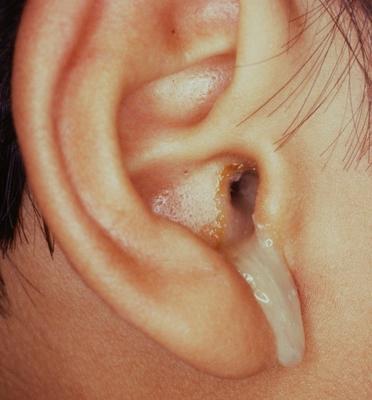 Çocuklar için kulak damlalarını kullanmak ne kadar doğru?