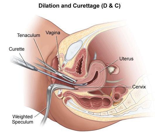 Yapay kürtaj: ne oldu? Endikasyonlar ve kontrendikasyonlar