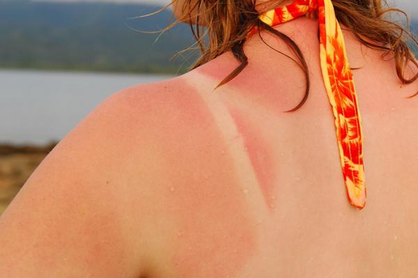 Güneş yanığı mıydın Böyle bir durumda bir cildi tedavi etmektense?